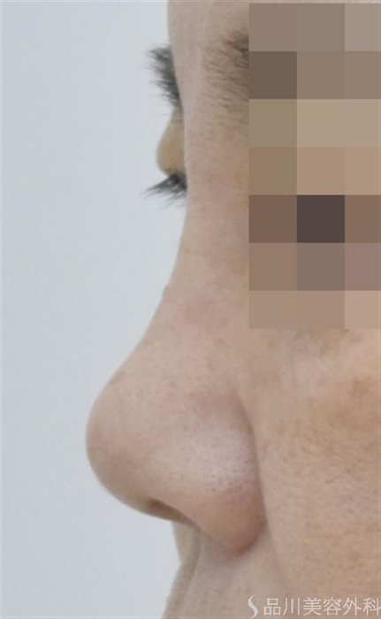 症例NO.51712のBEFORE写真