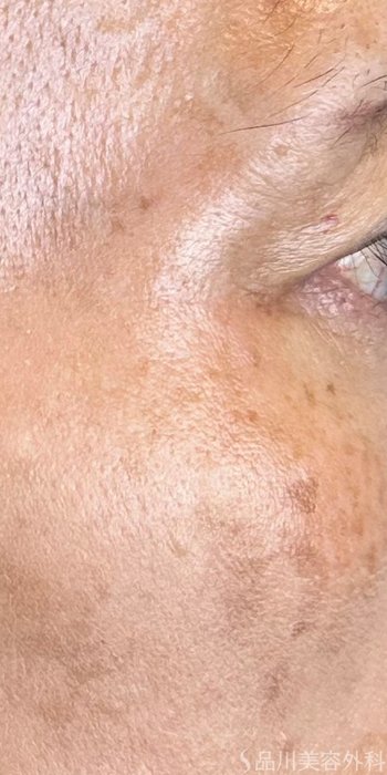 症例NO.72727のAFTER写真