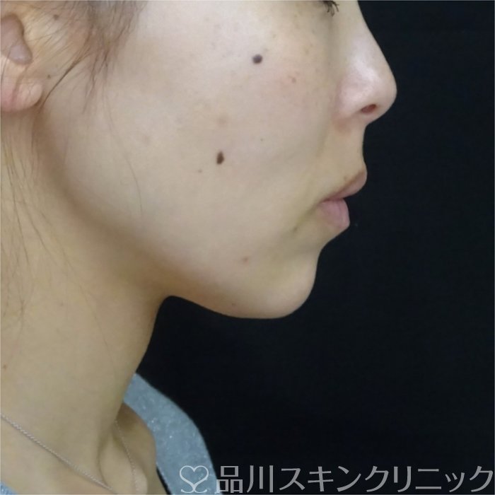 症例NO.70166のAFTER写真