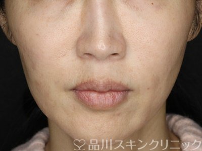 症例NO.71599のAFTER写真