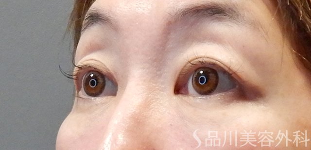 症例NO.67657のBEFORE写真