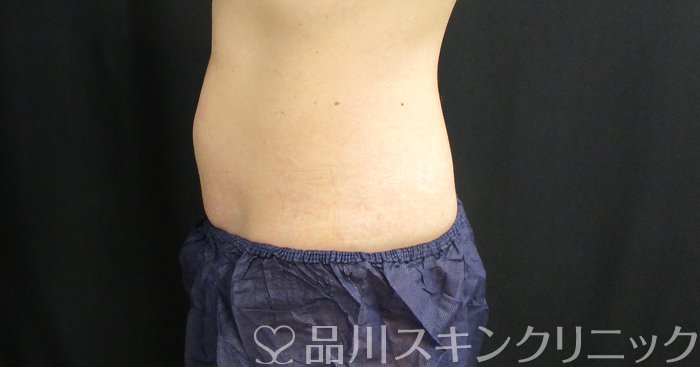 症例NO.72907のAFTER写真