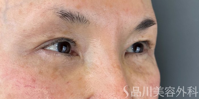 症例NO.72837のAFTER写真