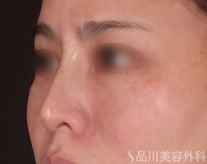 症例NO.69811のAFTER写真