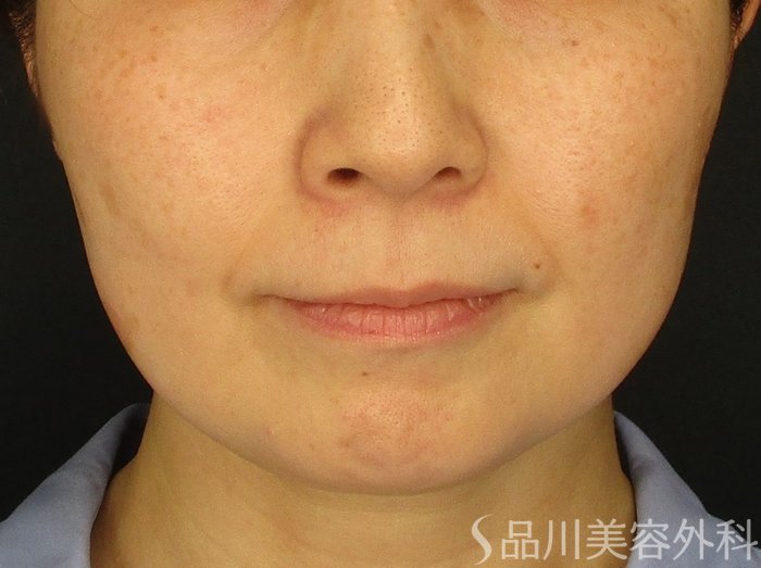 症例NO.74648のBEFORE写真