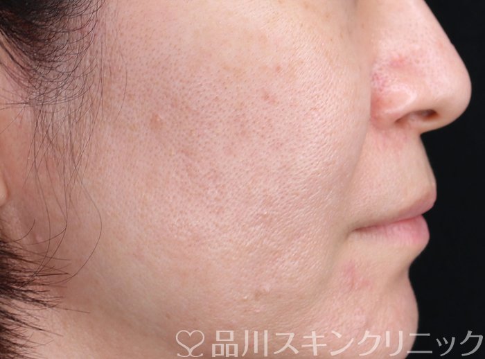 症例NO.70702のBEFORE写真