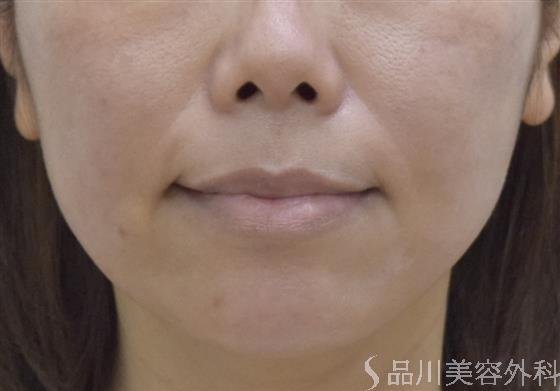 症例NO.48900のAFTER写真