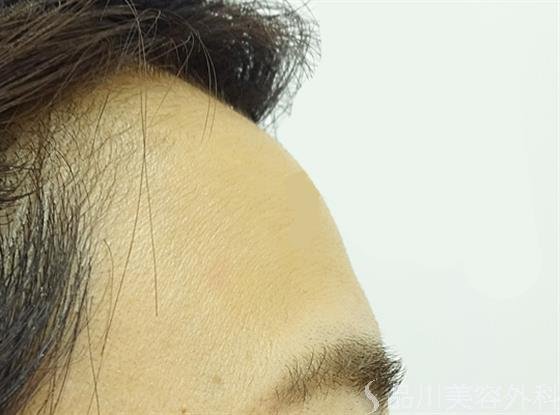症例NO.39615のBEFORE写真
