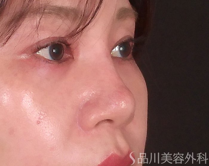 症例NO.69901のAFTER写真