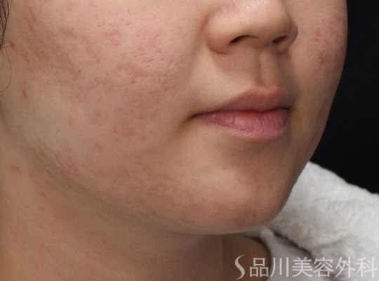 症例NO.73292のAFTER写真