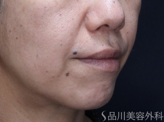 症例NO.73347のBEFORE写真