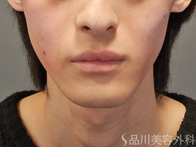 症例NO.73862のAFTER写真