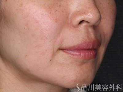 症例NO.70088のAFTER写真