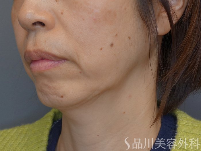 症例NO.72872のBEFORE写真