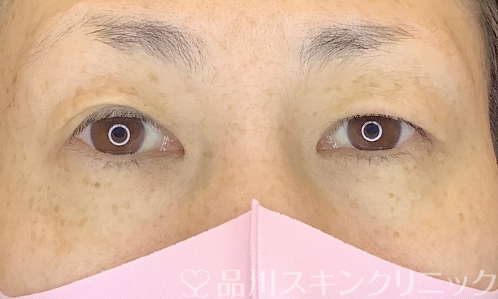 症例NO.65384のBEFORE写真