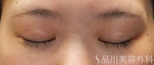 症例NO.71692のAFTER写真
