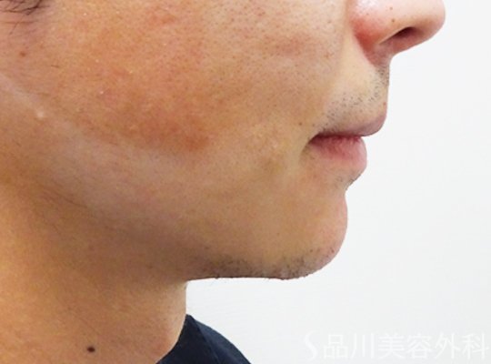 症例NO.71141のAFTER写真