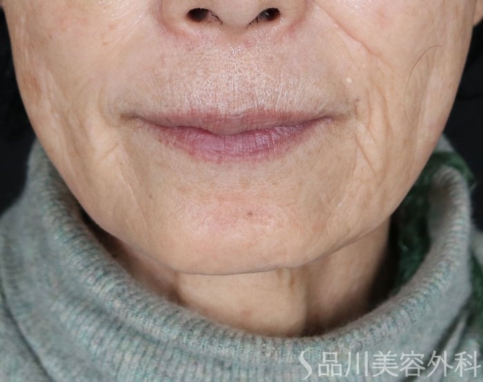 症例NO.72238のBEFORE写真