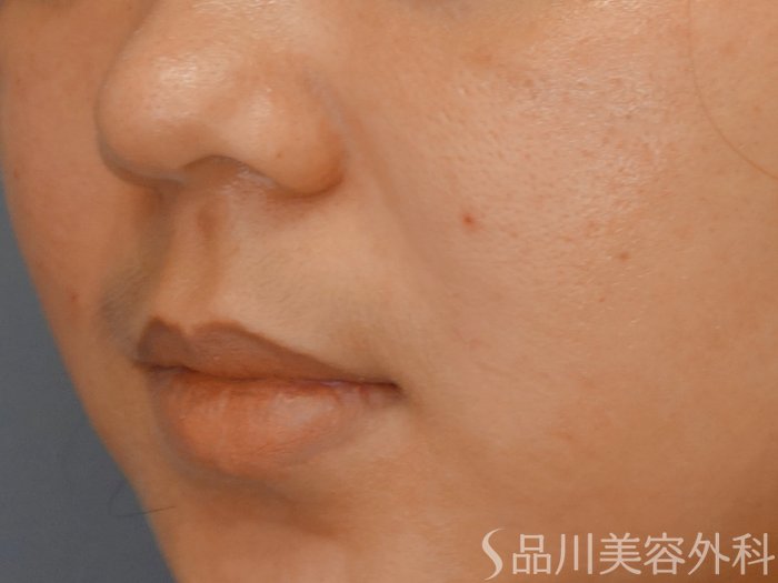 症例NO.70994のAFTER写真