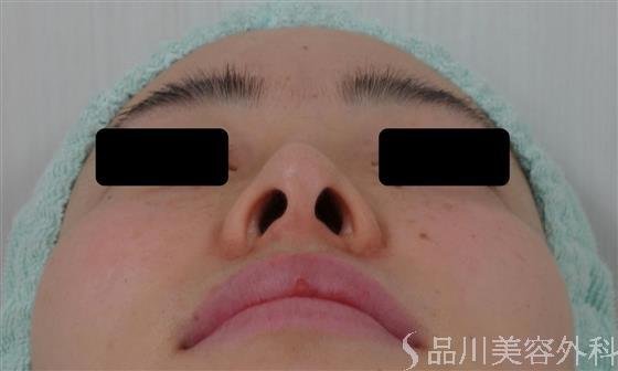 症例NO.27598のBEFORE写真