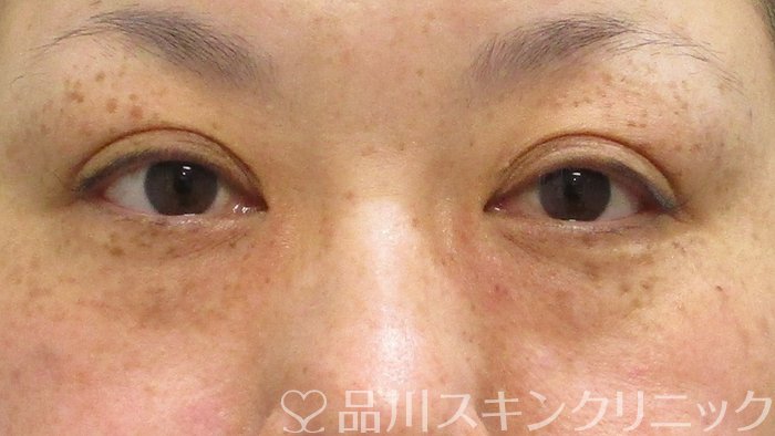 症例NO.64972のBEFORE写真