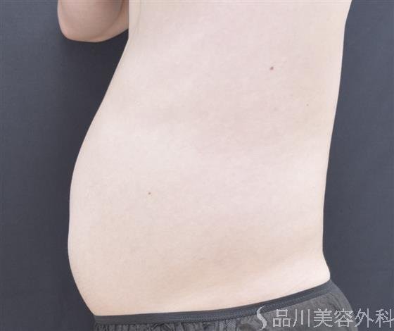 症例NO.44243のBEFORE写真