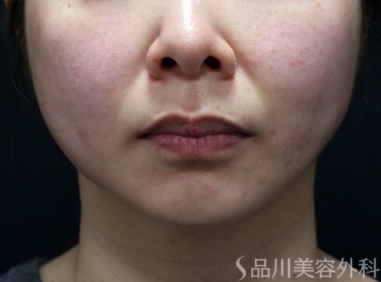 症例NO.73035のAFTER写真