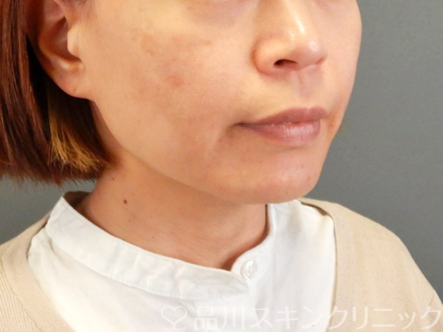 症例NO.63835のAFTER写真