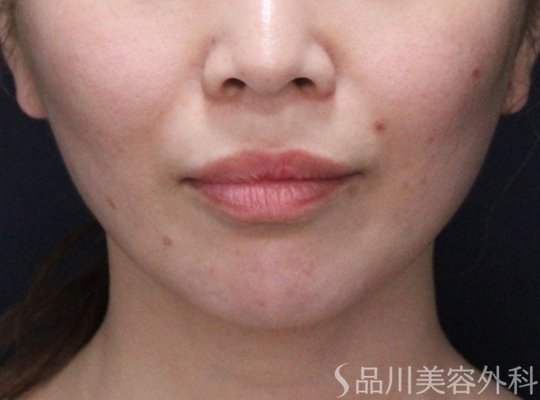 症例NO.73914のAFTER写真