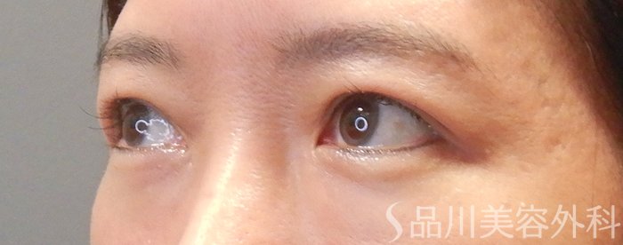 症例NO.67862のAFTER写真
