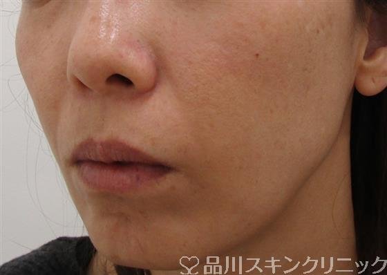 症例NO.43048のBEFORE写真