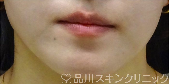 症例NO.69325のBEFORE写真