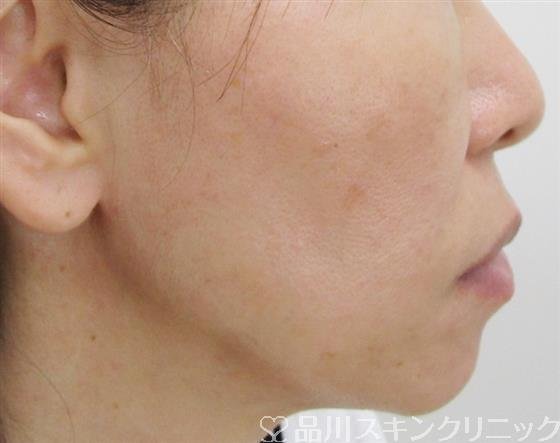 症例NO.42919のAFTER写真