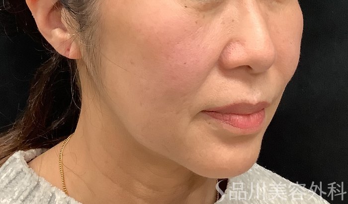症例NO.67964のBEFORE写真