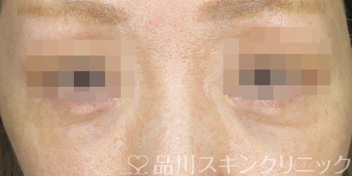 症例NO.62535のAFTER写真