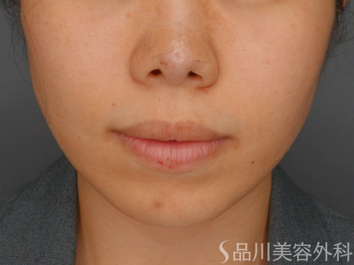 症例NO.73492のAFTER写真