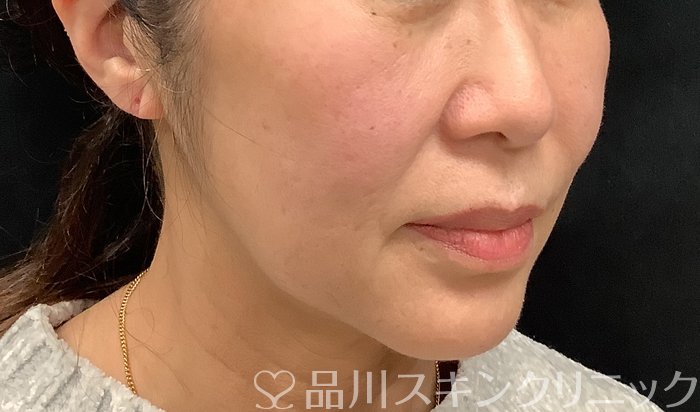 症例NO.67964のBEFORE写真