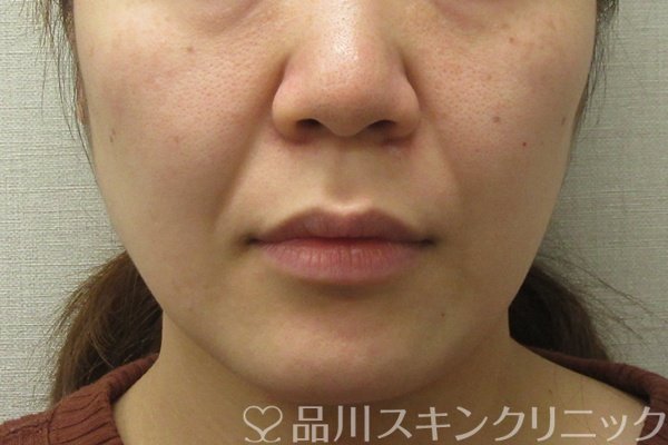 症例NO.74445のBEFORE写真
