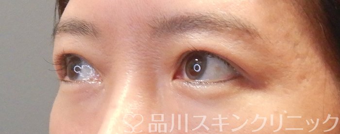症例NO.67862のAFTER写真