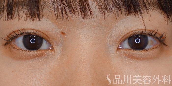 症例NO.72168のAFTER写真