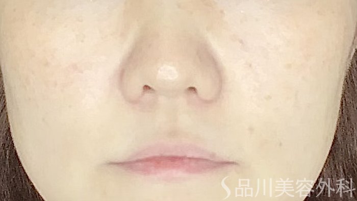 症例NO.67615のAFTER写真