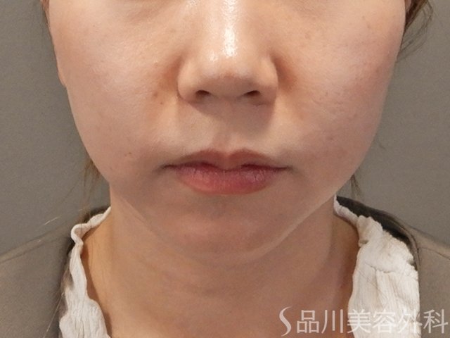 症例NO.74986のAFTER写真