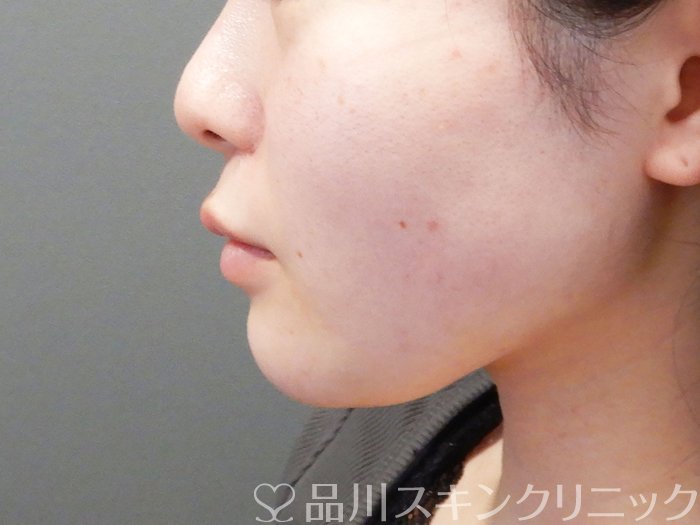 症例NO.72522のAFTER写真