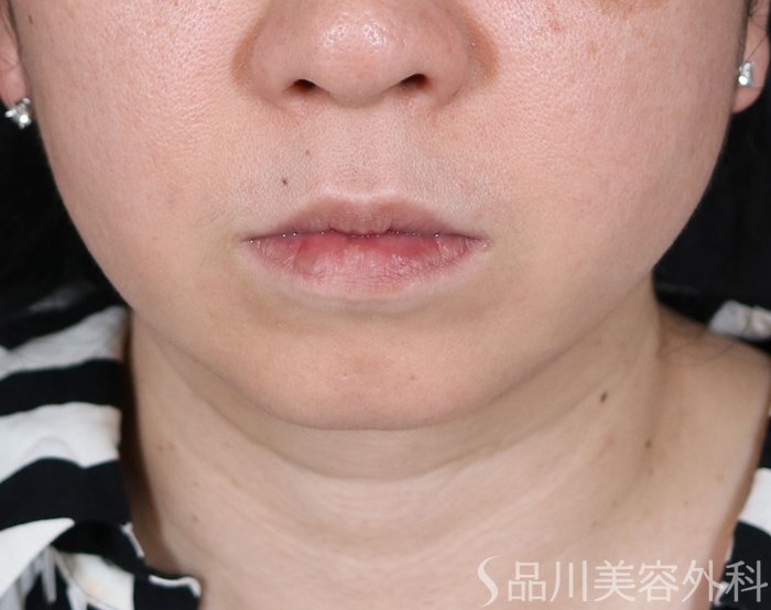 症例NO.71115のBEFORE写真