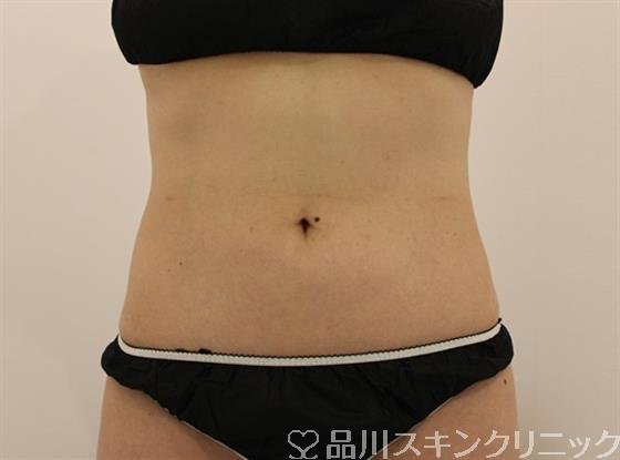 症例NO.49451のAFTER写真
