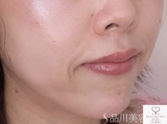 症例NO.68043のBEFORE写真