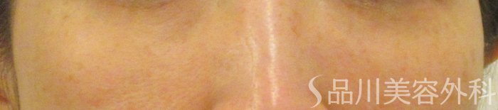症例NO.72100のAFTER写真