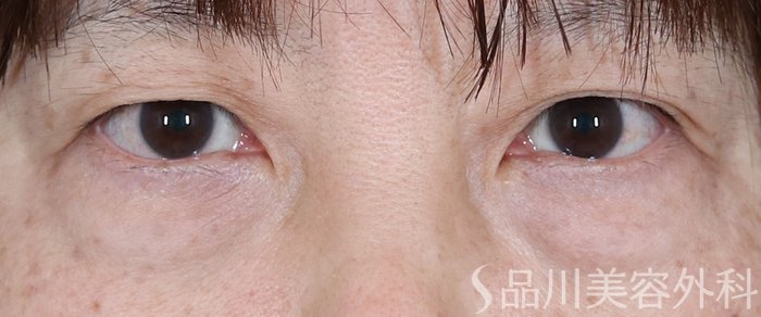 症例NO.71400のBEFORE写真