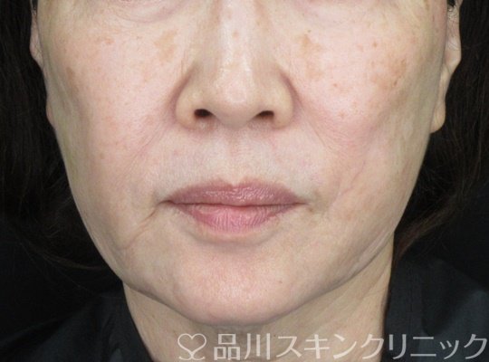 症例NO.69822のAFTER写真
