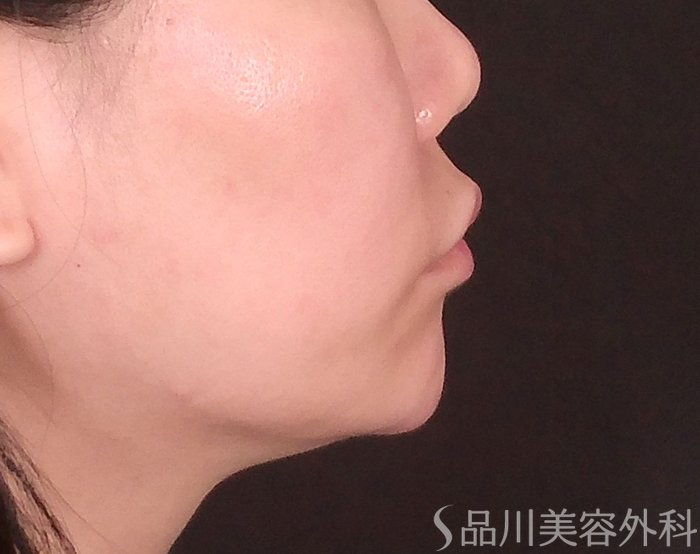 症例NO.69994のBEFORE写真